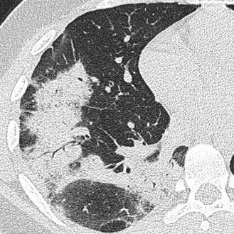 organising pneumonia