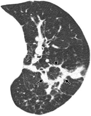 perilobular changes