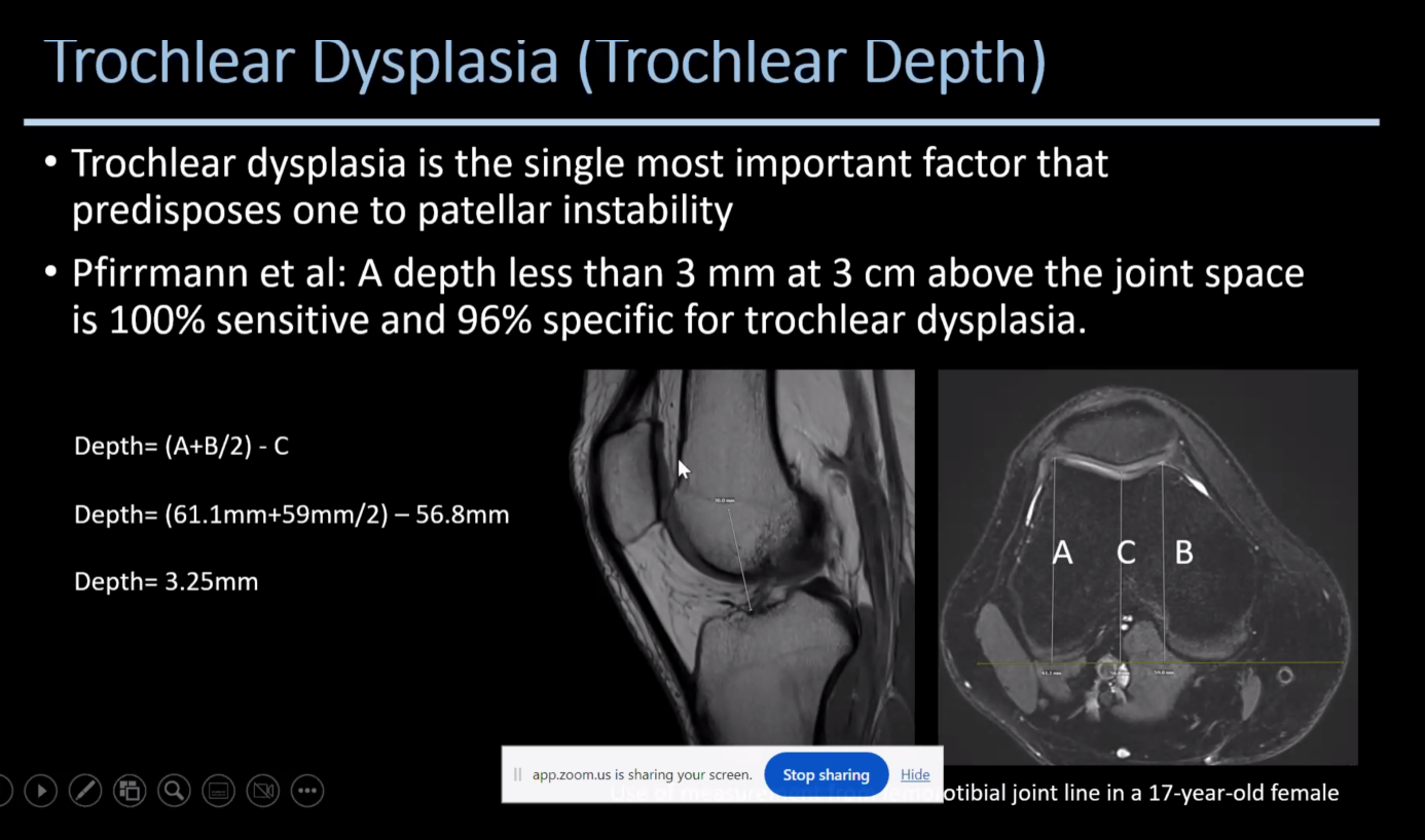 Patellar Maltracking