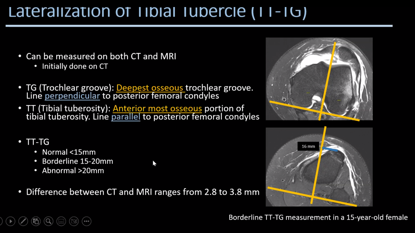 Patellar Maltracking