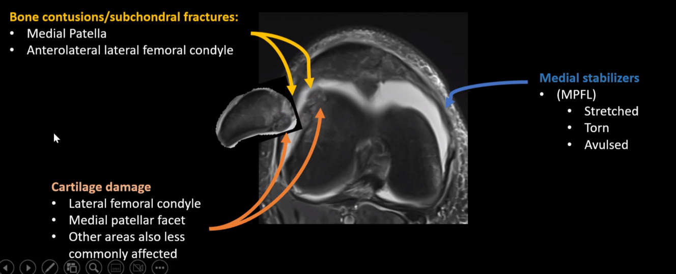 Patellar Maltracking