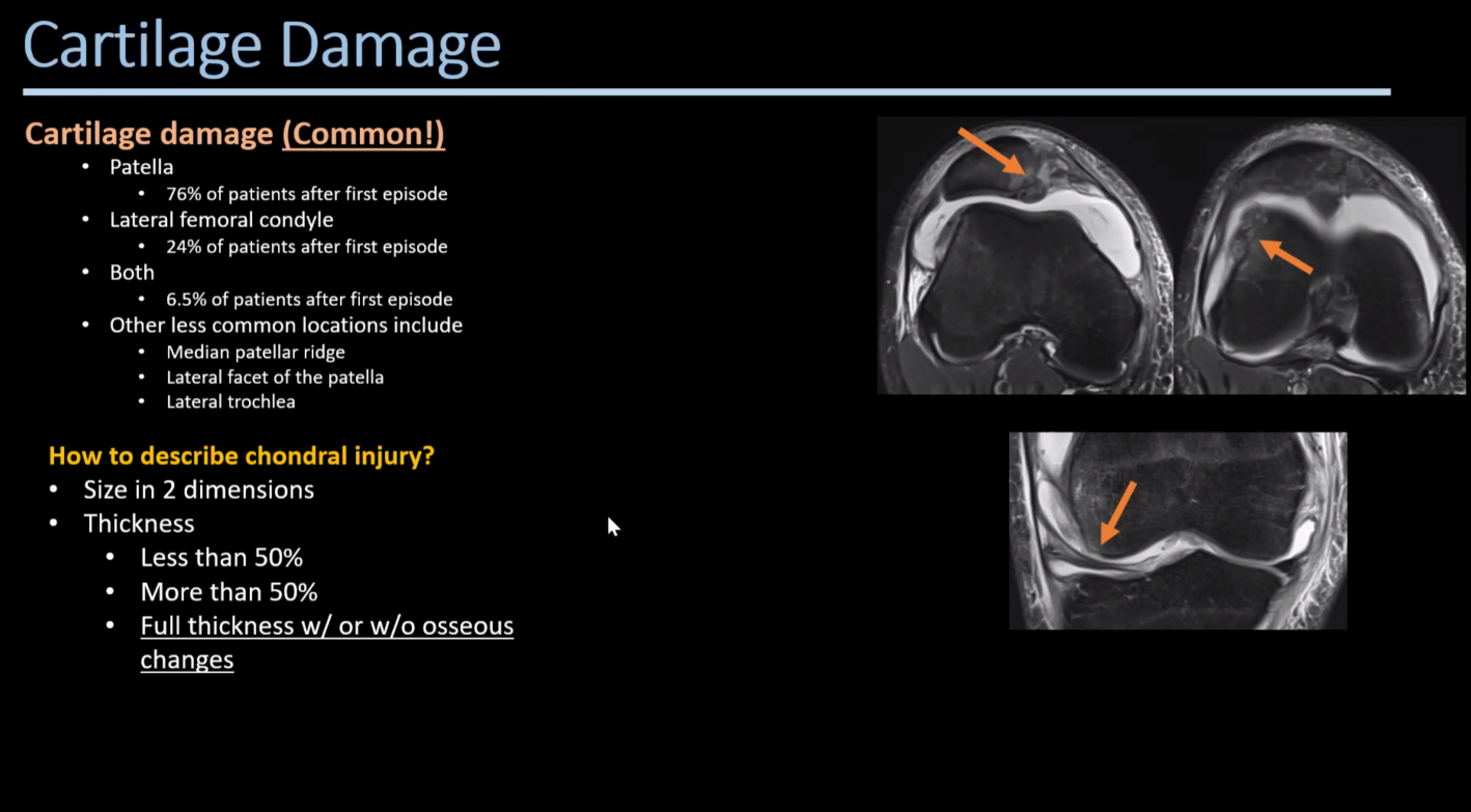 Patellar Maltracking