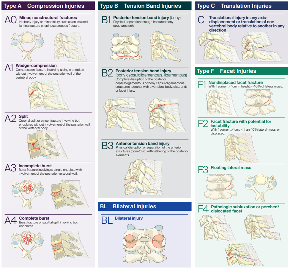 AO Subaxial Cervical Fracture