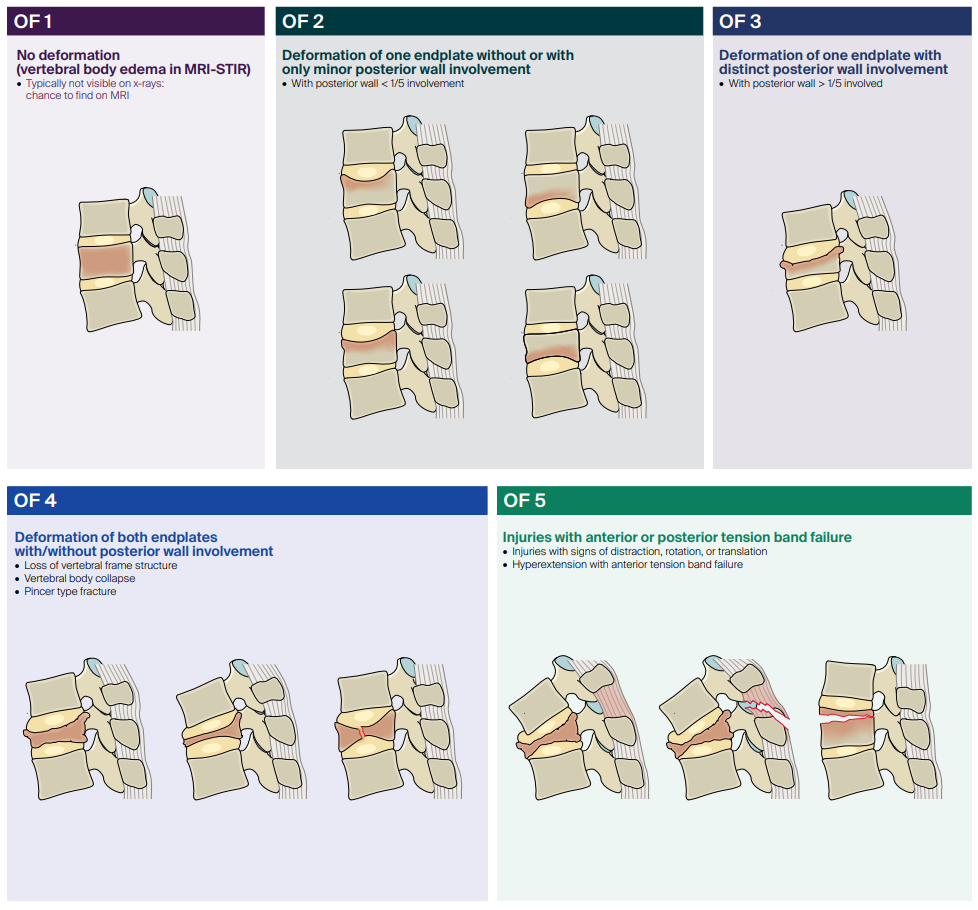 AO Osteoporotic Fracture