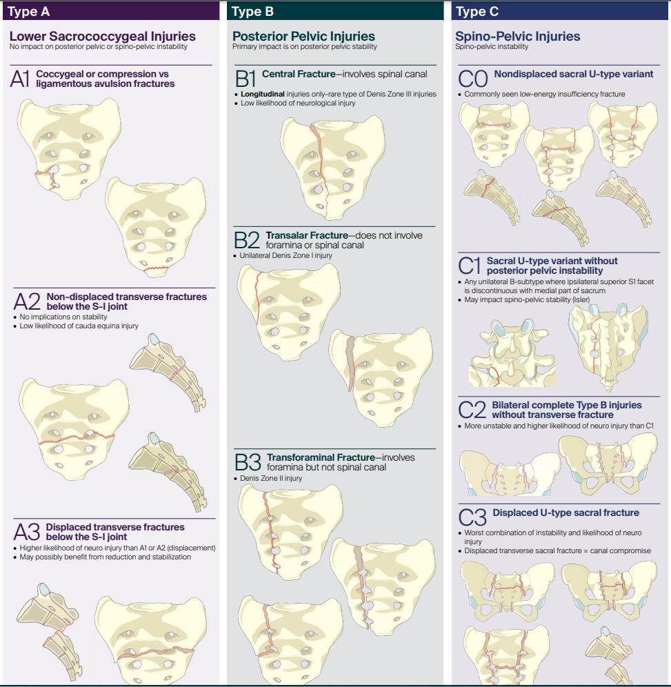 AO Sacral Fracture