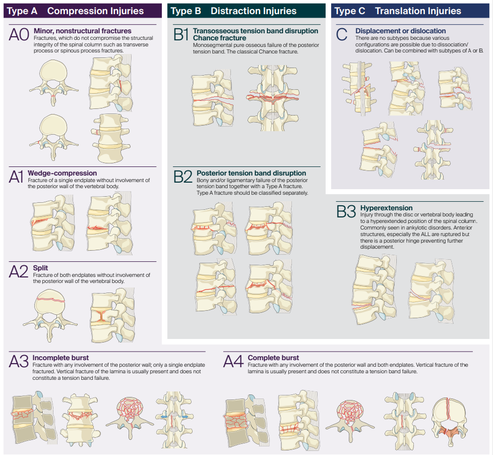 AO Thoracolumbar Injury score