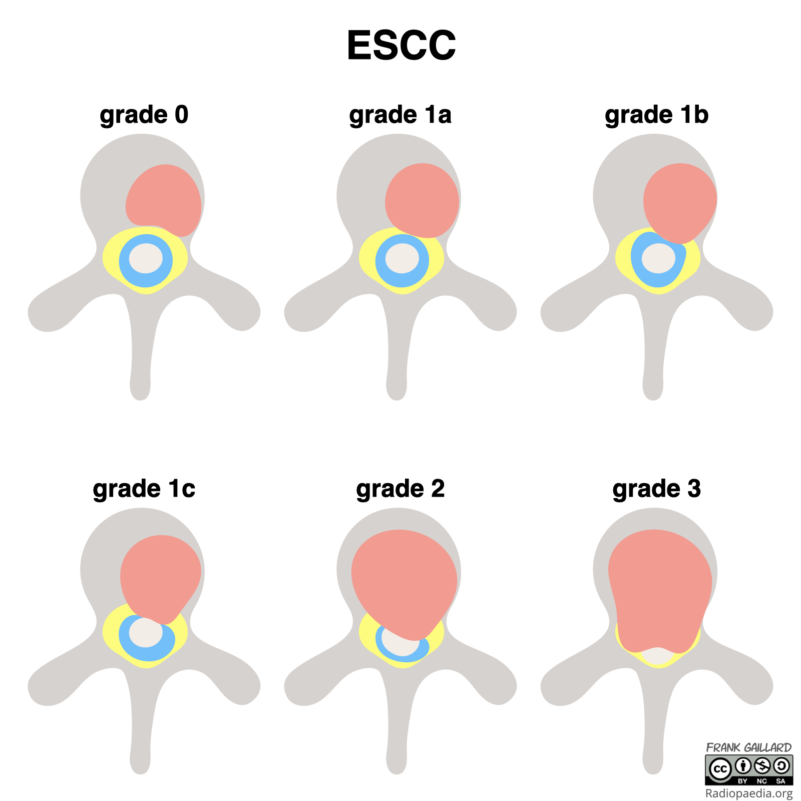 Epidural Spinal Cord Compression