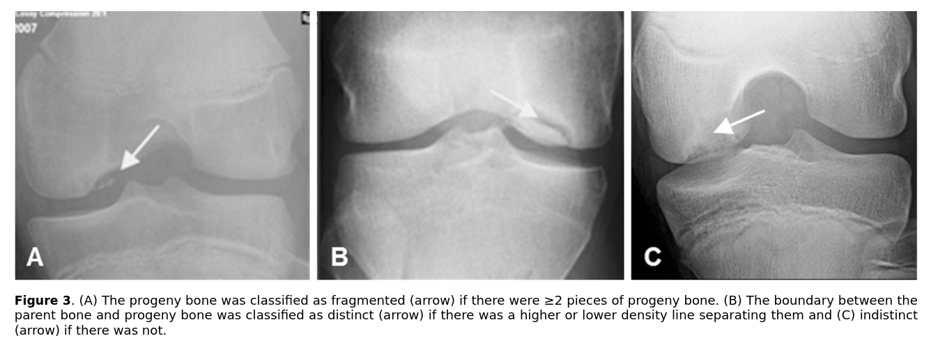 OCD in the knee