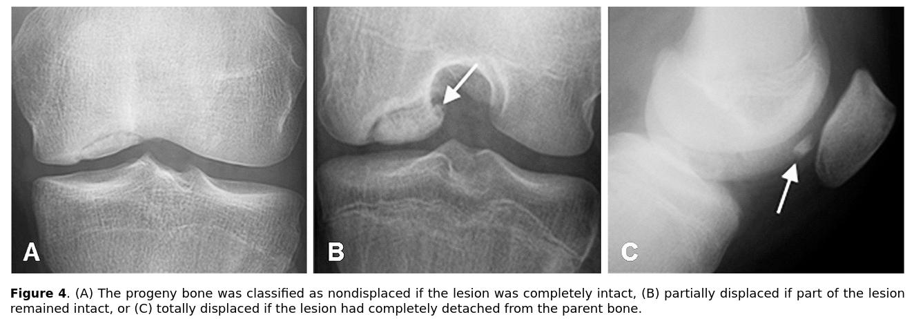 OCD in the knee