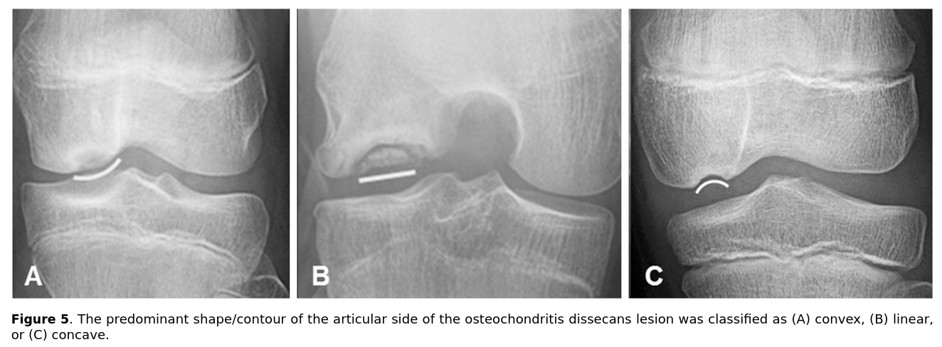 OCD in the knee