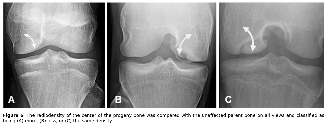 OCD in the knee