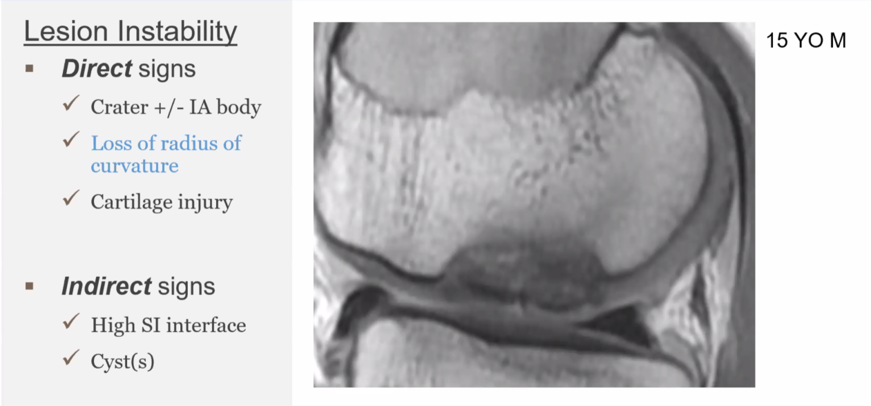 OCD in the knee