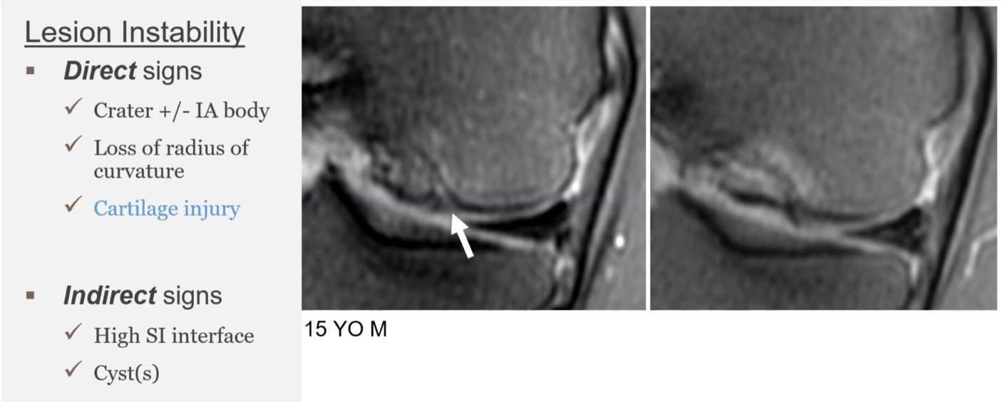 OCD in the knee