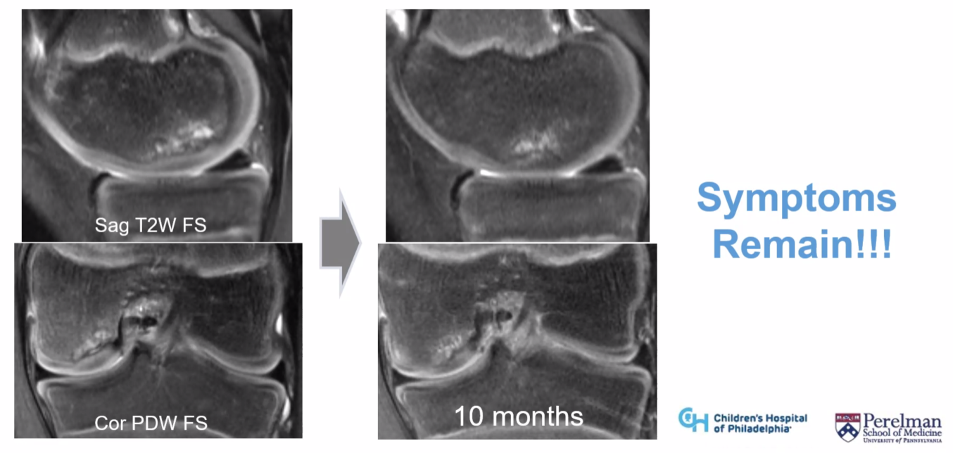 OCD in the knee