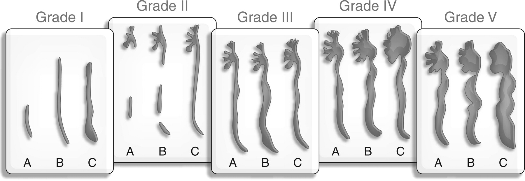 American Society of Nephrology Grade